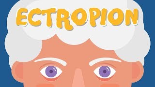 What is Ectropion [upl. by Main]