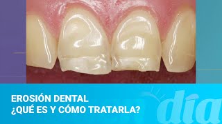 Erosión dental ¿Qué es y cómo tratarla [upl. by Hagar]