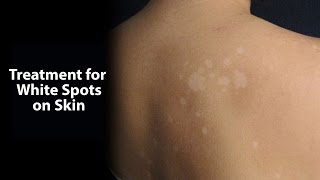 Treatment for White Spots on Skin [upl. by Derina]