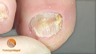 Thickened toenails  Thoroughly clearing the lateral and distal edge of the nails  Podology [upl. by Alice]