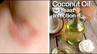 How To Cure A Yeast Infection Naturally At Home Using Coconut Oil [upl. by Spiegleman]