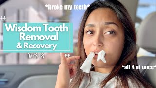 Getting all 4 of my wisdom teeth removed PAINFUL  Recovery days 18 [upl. by Aiciles]