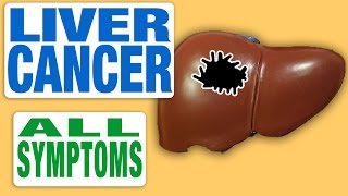 Liver Cancer  All Symptoms [upl. by Tolkan]