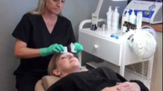 CHEMICAL PEEL Full Process  Procedure  Peeling  Before amp After [upl. by Sheldon553]