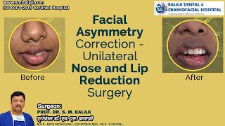 Facial Asymmetry Correction  Unilateral Nose and Lip Reduction Surgery [upl. by Aiyot609]