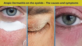 Atopic Dermatitis on the eyelids – The causes and symptoms  Nuse Healthy [upl. by Yezdnil513]