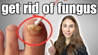 Get Rid Of Toenail Fungus With These 4 Easy Home Remedies [upl. by Ainad481]