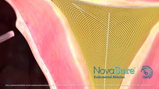 Animated Clip The NovaSure procedure animation featuring SmartDepth technology [upl. by Ssilb]