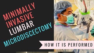 Minimally Invasive Lumbar Microdiscectomy Video  How Its Performed [upl. by Thomsen516]