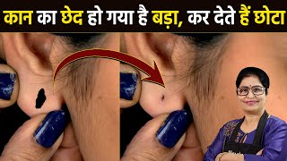 बिना ऑपरेशन बिना टांके  सिर्फ 10 सेकंड में कान का बड़ा छेद करें छोटा  How To Reduce Ear Hole Size [upl. by Ahsiral]