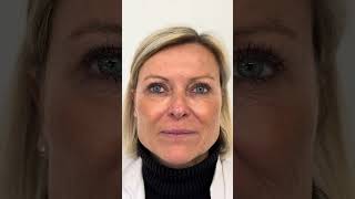 Évolution des rides du front après injection de botox [upl. by Thorne229]