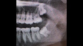 Technique step by step impacted third molar extraction [upl. by Oxford]