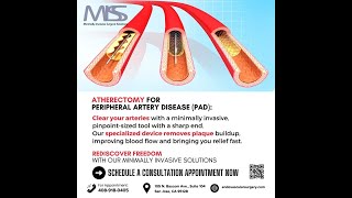 Clear Arterial Blockage With Atherectomy at MISS [upl. by Ahmad303]