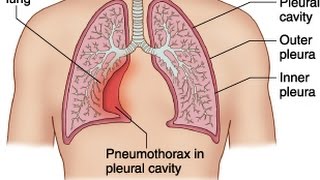 Pneumothorax [upl. by Jules]