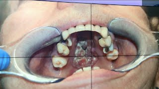 Warning signs of oral cancer [upl. by Novyar650]