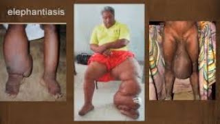 Comment soigner naturellement l’ELEPHANTIASIS [upl. by Valonia]