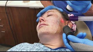 Full Face Fractional CO2 Laser Resurfacing for Wrinkles and Skin Tightening [upl. by Kaliski339]