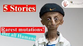 Rarest Disease Meet Nihal and Other Touching Stories of People With Rare Mutations  Body Bizarre [upl. by Eiramlirpa558]