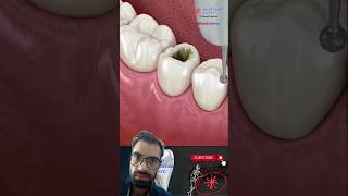 Dental Restoration ↪ Composite Bonding Teeth ↪ 3D Medical Animation [upl. by Nipsirc94]