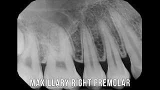 XRay lesson series 1  Full Mouth X rays [upl. by Novaj]