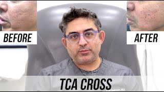 TCA Cross for Acne Scar  Los Angeles [upl. by Yelyah]