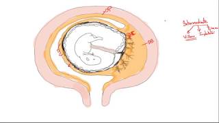 Gestational trophoblastic disease part 1 Introduction [upl. by Itaws]