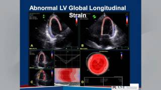 Echocardiographic Assessment of LV Diastolic Function Webinar [upl. by Ezekiel60]