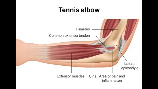 Tennis Elbow Cant Wait [upl. by Alakam]