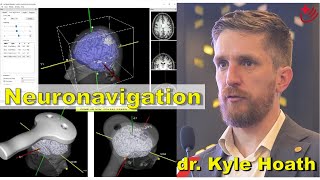 TMS  Neuronavigation  dr Kyle Hoath Australia [upl. by Marys]