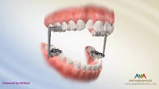 Orthodontic Treatment for Overjet Overbite  AdvanceSync Appliance [upl. by Filler]