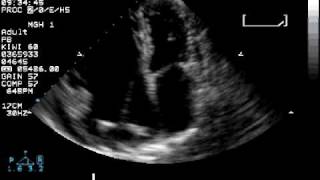 Arrhythmogenic right ventricular dysplasia [upl. by Jen]