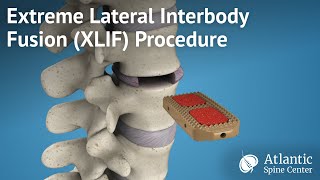 Low Back Pain Lumbar Laminectomy Surgery [upl. by Eniawd796]