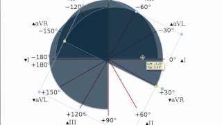 Easy EKG Mean Electrical Axis Made Easy [upl. by Rawdon]