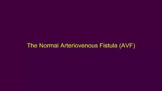 The Normal Arteriovenous Fistula [upl. by Stalker]