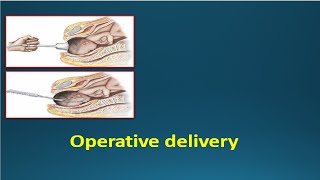 OPERATIVE DELIVERY  Instrumental deliveries Vacuum amp Forceps [upl. by Brenden]