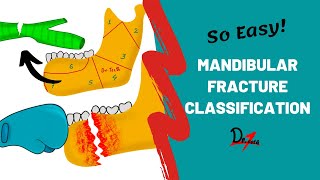 Mandibular Fracture Classification  DENTAL NOTES [upl. by Normy]