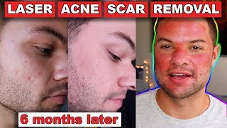 Acne Scar Removal Before And After 6 Months Fractional C02 Laser Skin Resurfacing [upl. by Faun]