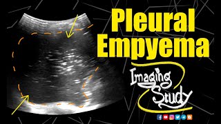 Pleural Empyema  Ultrasound  Case 156 [upl. by Mezoff876]