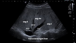 Ultrasound Abdomen Liver Segments Clips and Questions [upl. by Jacky544]