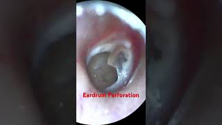 Perforated Eardrum [upl. by Anuaek]