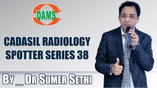 CADASIL Radiology Spotter Series 38 By Dr Sumer Sethi [upl. by Terrie]