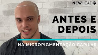 Antes e depois na Micropigmentação Capilar Nicolas [upl. by Netsrejk]