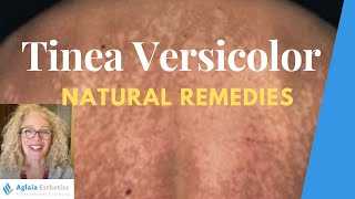 NATURAL HOME REMEDIES FOR TINEA VERSICOLOR [upl. by Bartholemy]