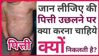 Pitti Uchalne Par Kya Karte Hai  Urticaria Causes And Treatment  Pitti  Dadore  Hives  Allergy [upl. by Elimay218]