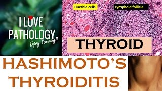 HASHIMOTOS THYROIDITIS Etiopathogenesis Morphology amp Complications [upl. by Lugo]