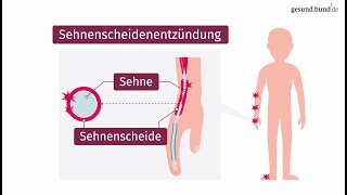 Was ist eine Sehnenscheidenentzündung [upl. by Woehick]