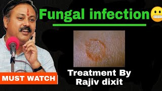 Ayurvedic Fungal infection Treatment By Rajiv dixit [upl. by Roseanne]