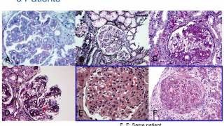 Understanding Membranoproliferative Glomerulonephritis Part 2 Hot Topic [upl. by Lennie]