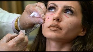 Juvederm Under Eye Filler Procedure  NJ Plastic Surgeon Dr Asaadi [upl. by Angelita43]