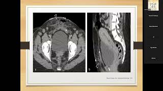 Postpartum obstetric complication Dr Eman Montaser Dr Ffatemazahraa DEnewar [upl. by Sanchez]